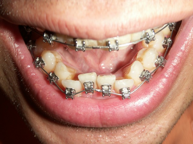 Olivers Unterkiefer mit Zahnspange